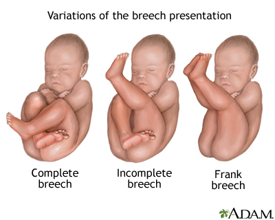 Breech Presentation