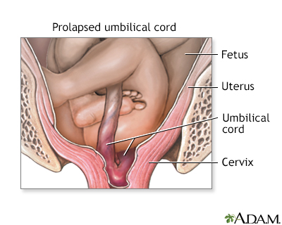 Complications of breech