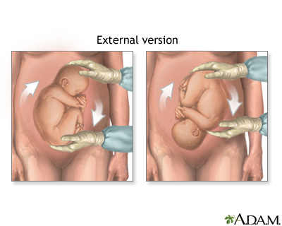 Correcting breech