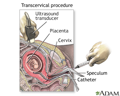 Chorionic Villus Sampling