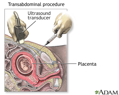 Chorionic Villus Sampling