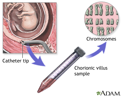 Chorionic Villus Sampling