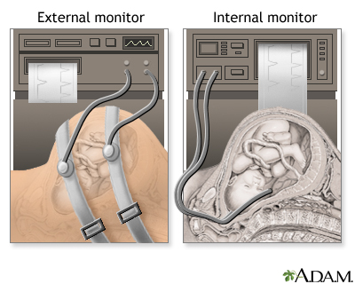 Procedure - Epidural 5