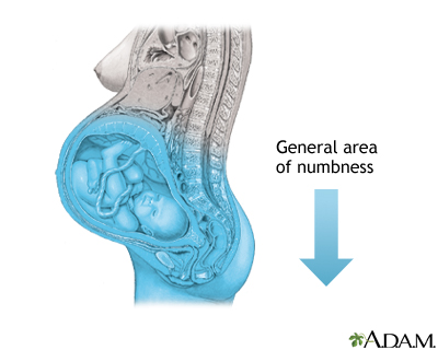 Procedure - Epidural 6