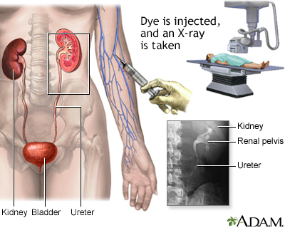 Intravenous pyelogram (IVP)