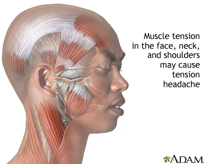 Tension-type headache