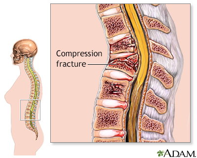 Orthopedics Center - Compression spinal fracture