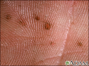 Basal cell nevus syndrome - close-up of palm