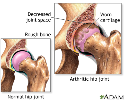 Osteoarthritis