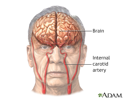 Stroke - Series