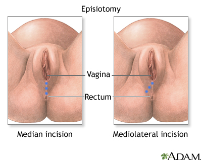 Episiotomy