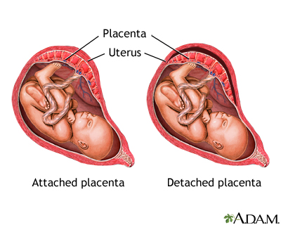 Abruptio Placenta