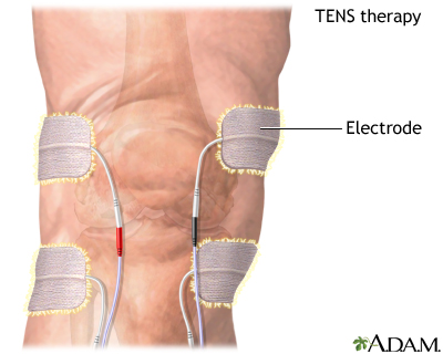 Position of transcutaneous electrical nerve stimulation (TENS)