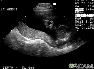 Ultrasound, normal relaxed placenta