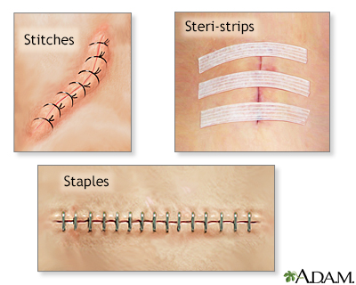 Incision closures