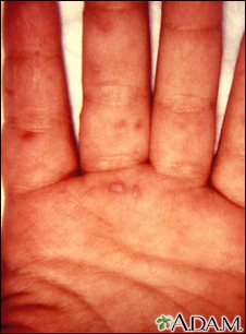 Hand, foot, and mouth disease on the hand