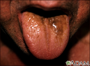 Black hairy tongue