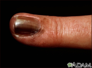 Skin cancer, melanoma on the fingernail