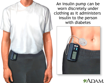 Insulin pump