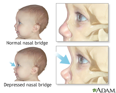 Depressed nasal bridge