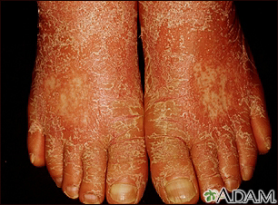 Pityriasis rubra pilaris on the feet