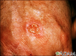 Skin cancer, squamous cell - close-up