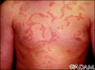 Hives (urticaria) on the chest