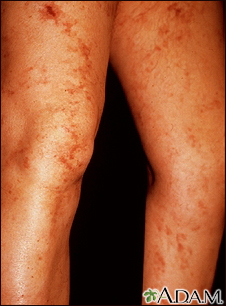 Livedo reticularis on the legs