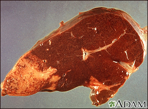 Hodgkin's disease - liver involvement