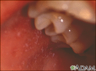 Measles, Koplik spots - close-up