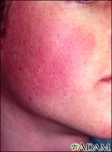 Keratosis pilaris rubra faceii