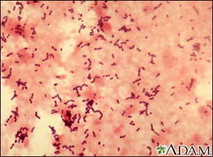 Pneumococcal pneumonia