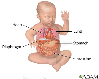 Diaphragmatic hernia repair - series