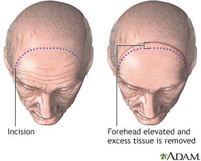 Forehead lift - Procedure