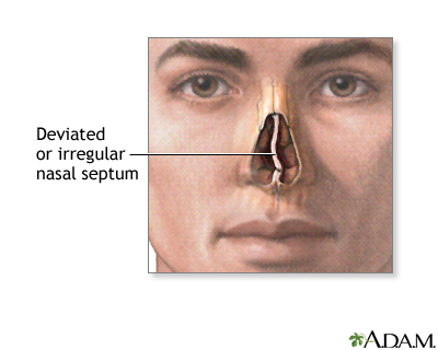 Indications - Septal deviation