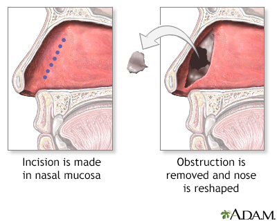 Procedure