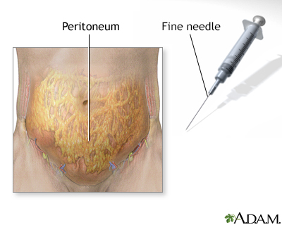 Peritoneal fluid sampling