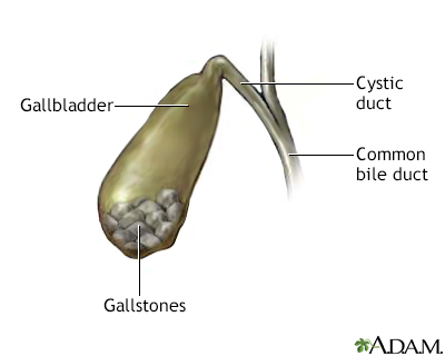 Gallstones