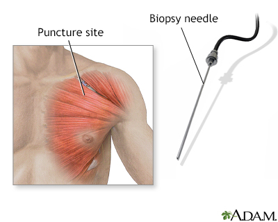 Muscle biopsy