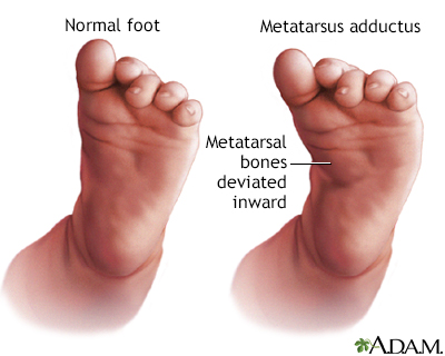 Metatarsus adductus