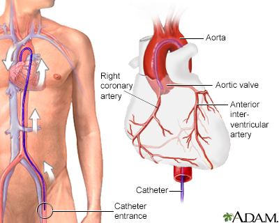 Cardiac arteriogram