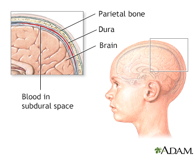 Increased intracranial pressure