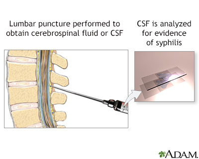 CSF test for syphilis