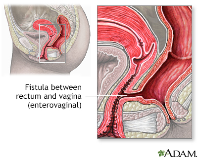 Fistula