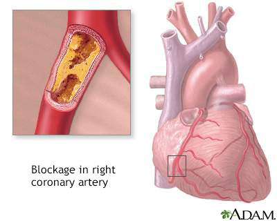 Coronary artery blockage