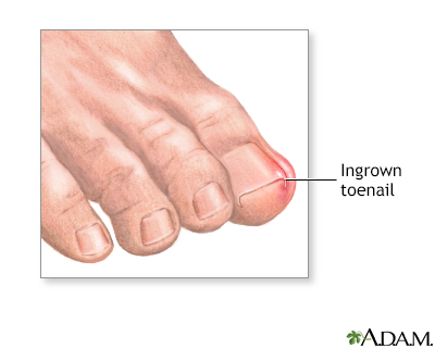 Ingrown toenail