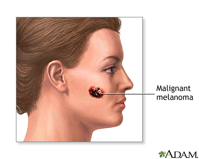 Malignant melanoma