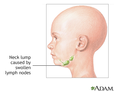 Neck lump