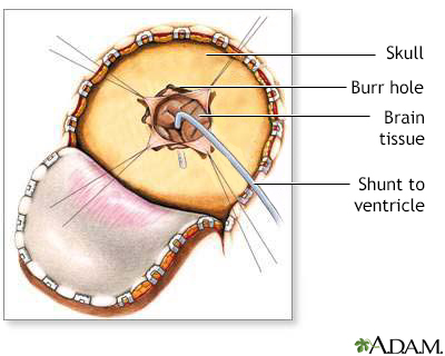 Craniotomy for cerebral shunt