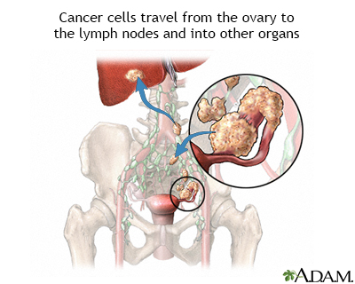 Ovarian cancer metastasis